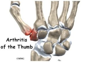 Base of thumb surgery - Suspensionplasty