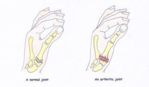 Osteoarthritis