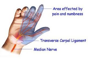 Carpal Tunnel Syndrome / Release | Geelong Hand Therapy