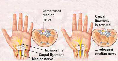 I have had CTR surgery done – What happens now?