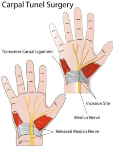 di-hand-Carpal-Tunnel-Surgery-600 | Geelong Hand Therapy