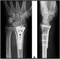 A Broken Wrist - Distal Radius fracture.