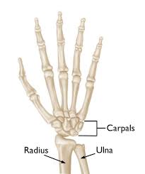 A Broken Wrist - Distal Radius fracture.