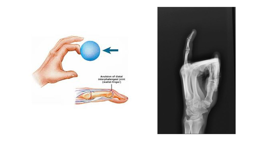 Mallet finger Why won’t the end of my finger straighten? Geelong