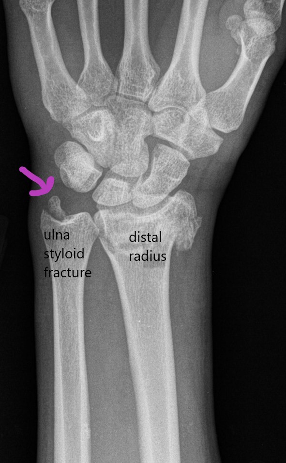 styloid process of radius pain