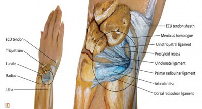 Ulnar Sided Wrist Pain, TFCC tear