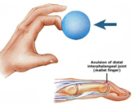 Mallet finger - Why won’t the end of my finger straighten?