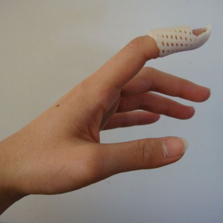 Mallet finger - Why won’t the end of my finger straighten?