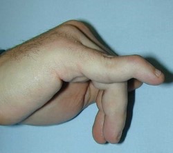 Mallet finger - Why won’t the end of my finger straighten?