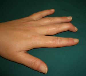 Mallet Finger – Geelong Hand Therapy