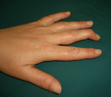 Mallet Finger