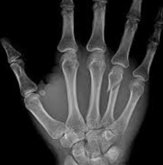 Sport Highlight – Metacarpal Fractures