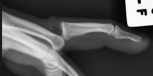 Sport Highlight – Volar Plate Injuries