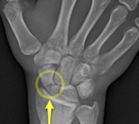 Sport highlight – Scaphoid fractures