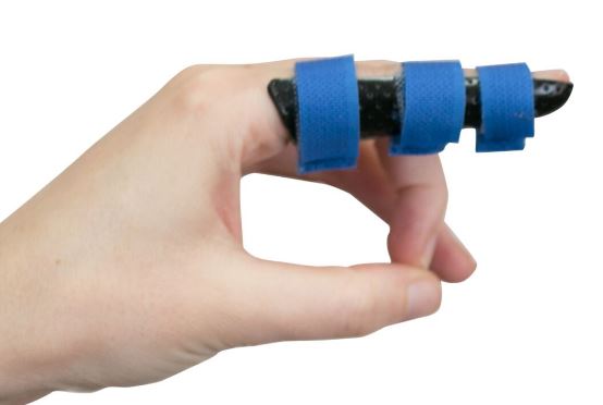 Custom made splints – Geelong Hand Therapy