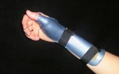 DeQuervain's Tenosynovitis