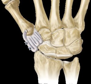 Base of thumb surgery - Suspensionplasty