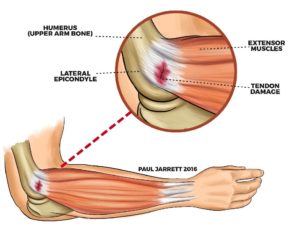 Tennis Elbow – is it really caused from playing tennis?