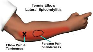 Tennis Elbow – is it really caused from playing tennis?