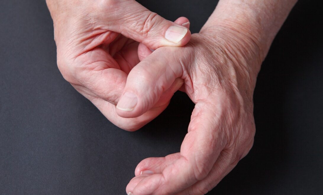 Base of thumb surgery Suspensionplasty Geelong Hand Therapy