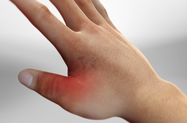 Sport highlight – Thumb UCL Injuries