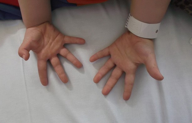 Paediatric Trigger Thumb