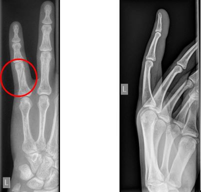 xray of broken finger